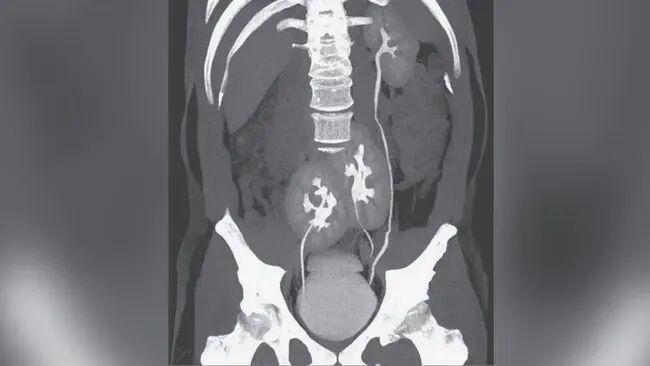  从一例罕见额外肾病例：深度解析先天性泌尿系统发育异常 健康养生